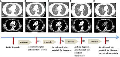 The occurrence of asthma in an extensive-stage small-cell lung cancer patient after combination therapy with atezolizumab and anlotinib: a case report